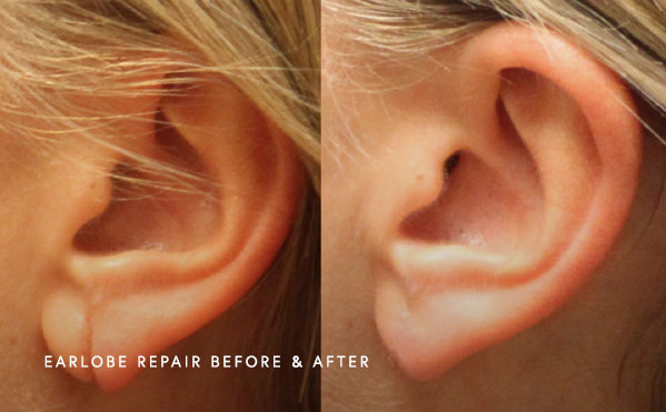 Earlobe repair in Fayetteville NC  - Before and after image