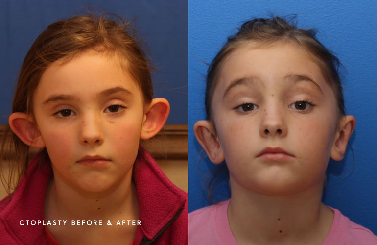 Ear Pinback (Otoplasty) in Fayetteville NC - Before & After image 1