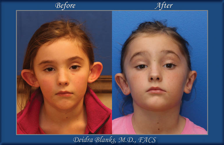 Ear Pinback (Otoplasty) Before & After img. 1