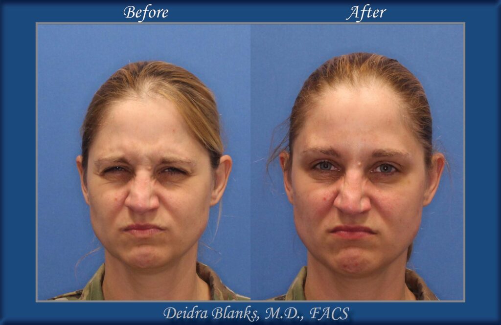 Botox Before & After img. 1