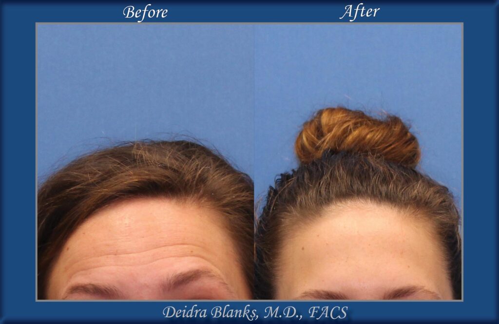 Botox in Fayetteville NC by Dr. Deidra Blanks Before & After img. 3