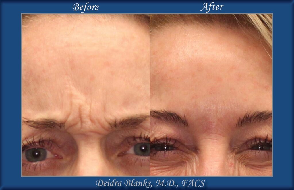 Botox in Fayetteville NC by Dr. Deidra Blanks Before & After img. 4