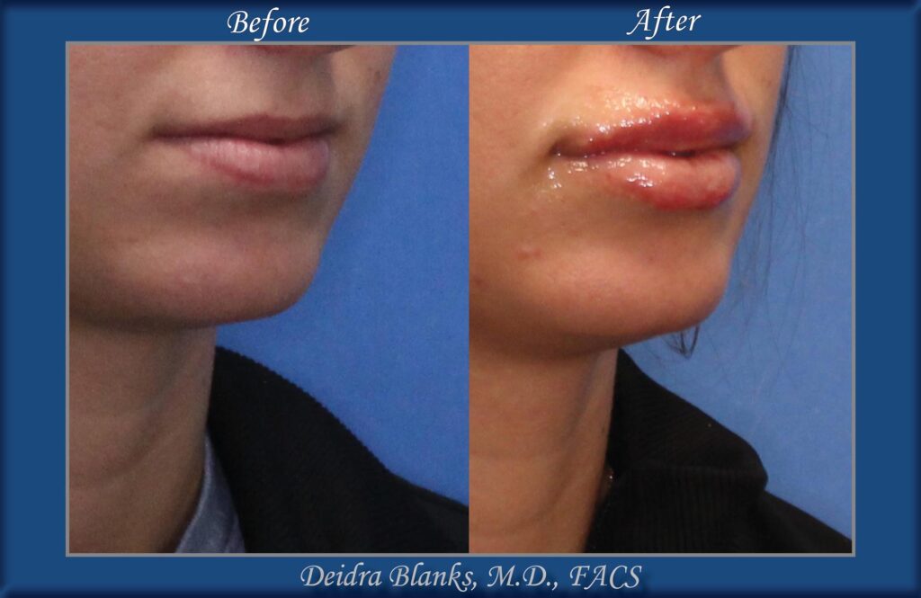 Lip Filler Before & After img. 5