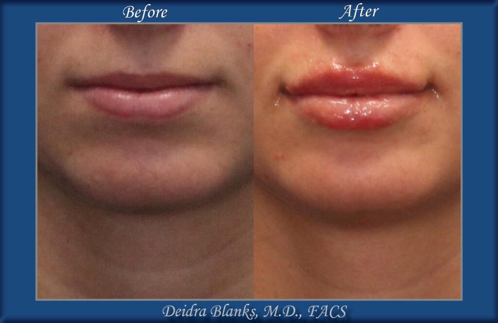 Lip Filler Before & After img. 6