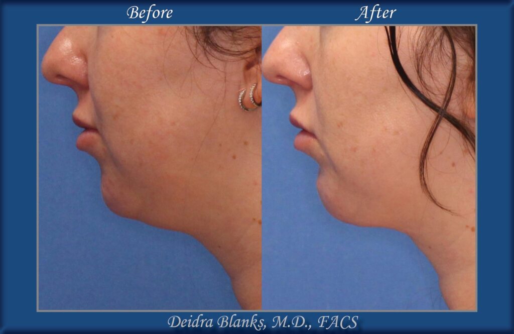 Chin Augmentation Before & After img. 3