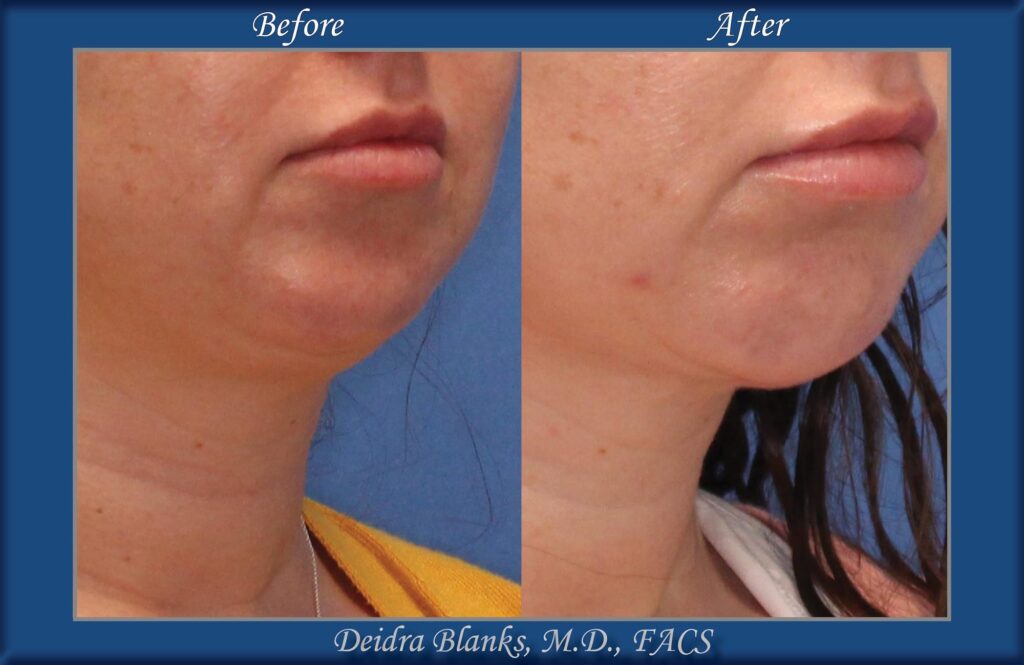 Chin Augmentation Before & After img. 2