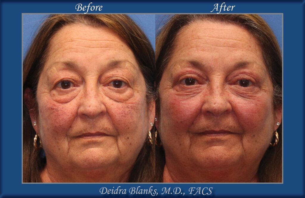 Upper & Lower Eyelid Surgery (Blepharoplasty) Before & After by Dr. Deidra Blanks img. 5