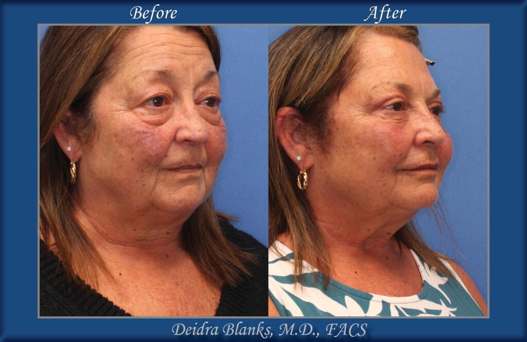 Upper & Lower Eyelid Surgery (Blepharoplasty) Before & After by Dr. Deidra Blanks img. 4