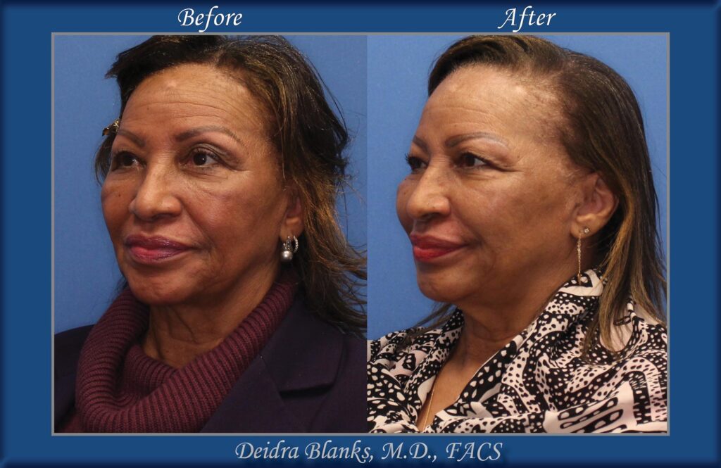 Facial Filler Before & After by Dr. Deidra Blanks, in Fayetteville, NC image 4