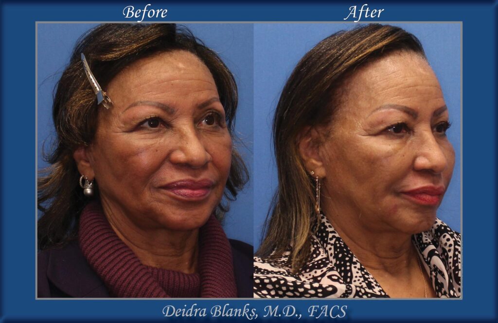 Facial Filler Before & After by Dr. Deidra Blanks, in Fayetteville, NC image 3