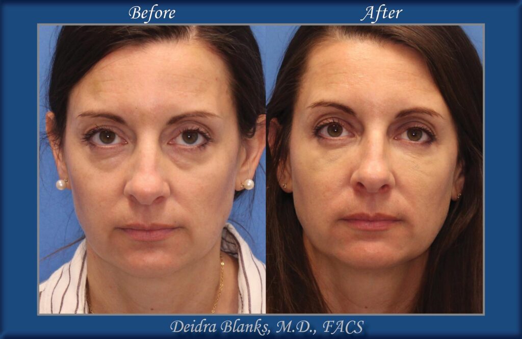 Lower Eye Facial Filler Before & After by Dr. Deidra Blanks, in Fayetteville, NC image 1