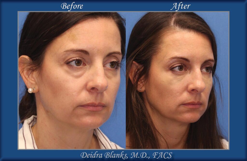 Lower Eye Facial Filler Before & After by Dr. Deidra Blanks, in Fayetteville, NC image 2